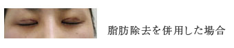 脂肪除去を併用した場合