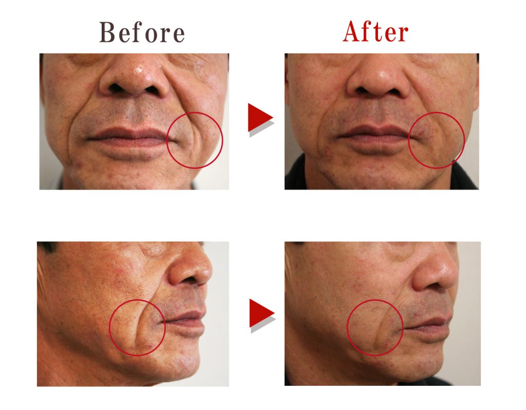 ハッピーリフト修正2