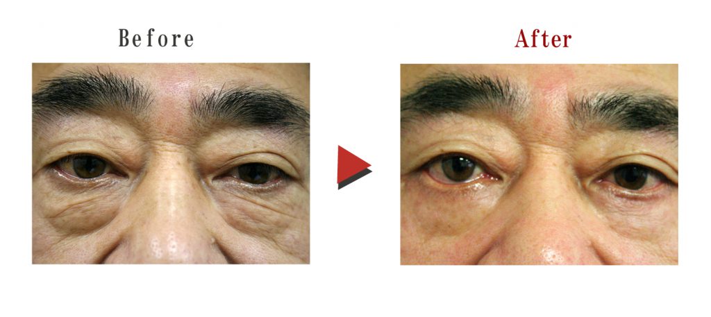 下まぶたたるみとり修正