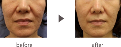 vivace_before-after